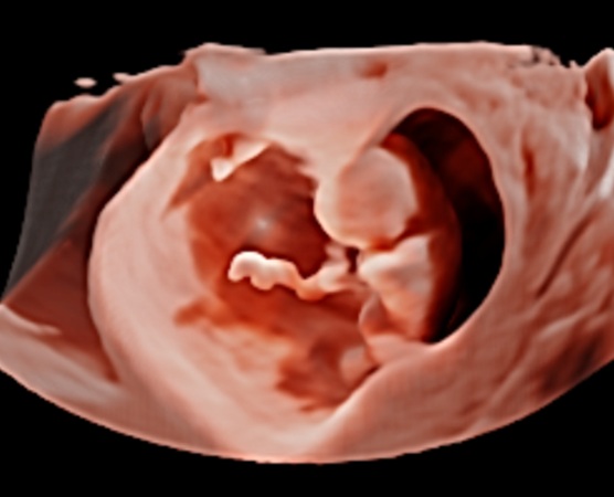 iViewLive ultrasound volume rendering